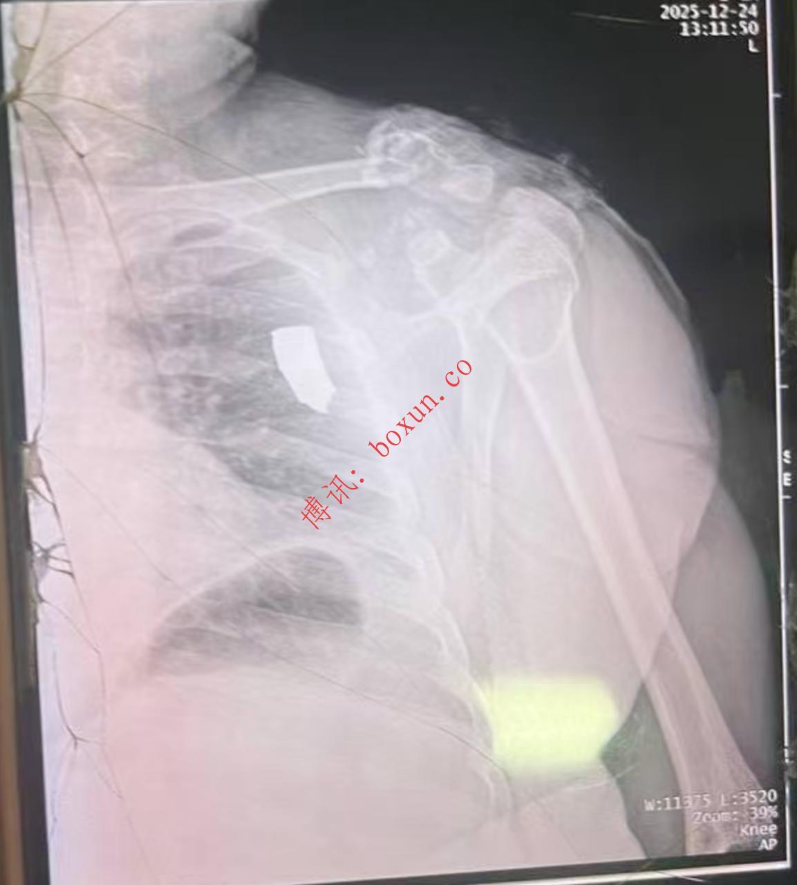 网友爆料波贝疑遭炮火波及 中国人居住区附近爆炸致一名中国公民重伤