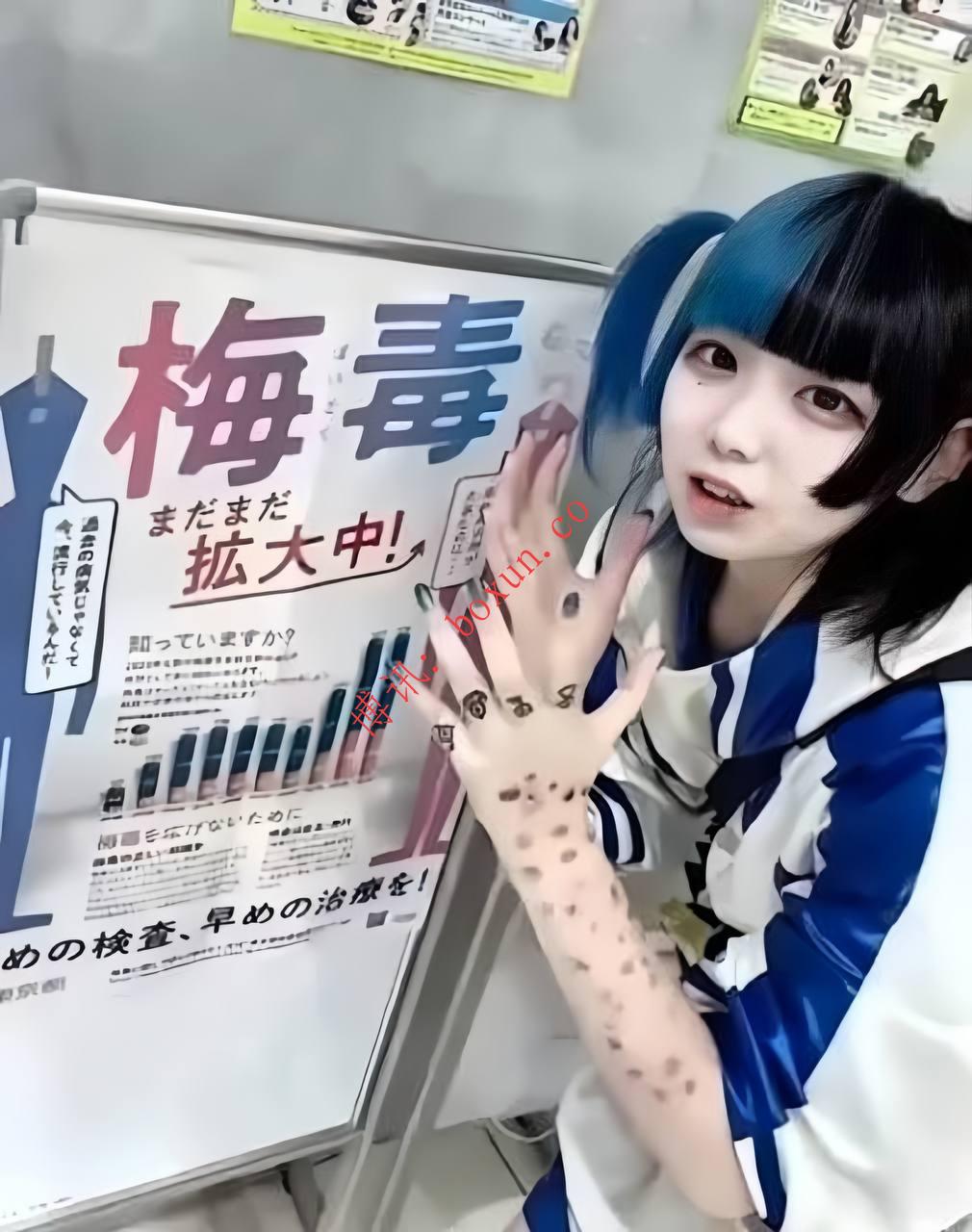 日本梅毒感染持续高位：确诊数连续四年突破1.3万例 引发公共卫生担忧